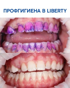 Профгигиена в стоматологии Liberty