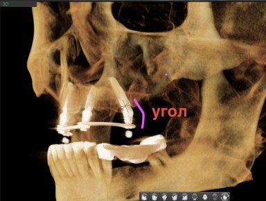 Как работает немедленная нагрузка на челюсть и зачем нужна монолитная конструкция